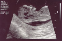 12weeksultrasound.jpg